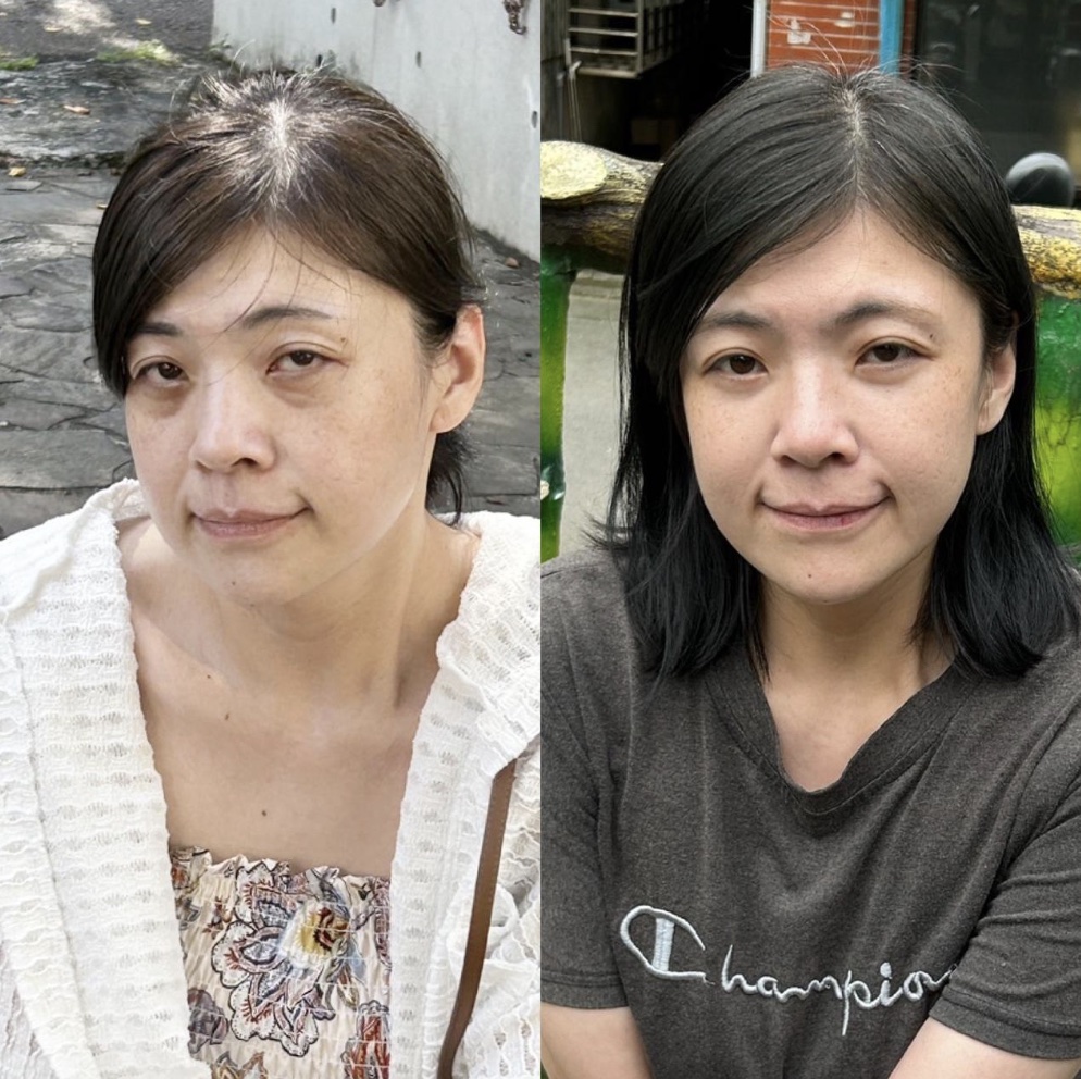 內開眼袋手術示意